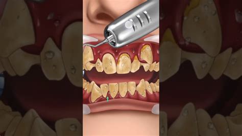 Asmr So Satisfying Caries Removal Animation Part Dental Care Molar