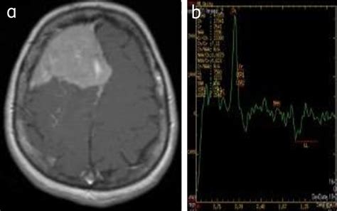 Convexity meningioma: (a) enhancing right frontal meningioma, (b) MRS ...