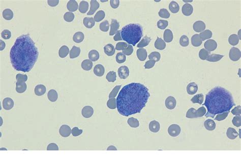 Figure From Acute Promyelocytic Leukemia Presenting With Central