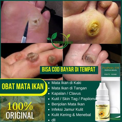 Jual Obat Mata Ikan Di Telapak Kaki Mata Ikan Di Kaki Tangan Salep