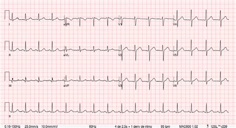 Electrocardiograma