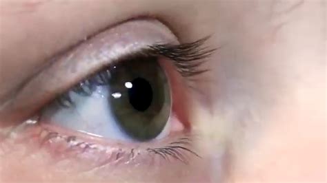 home remedies  dry eyes ivanhoe broadcast news