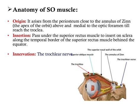 Superior oblique palsy