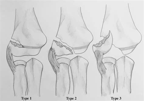 Type 1 2 And 3 Lateral Condyle Fractures According To The Jakob