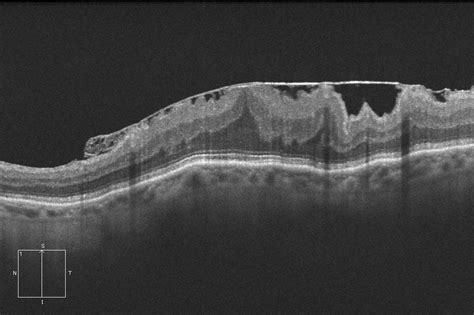 Epiretinal Membrane Oct