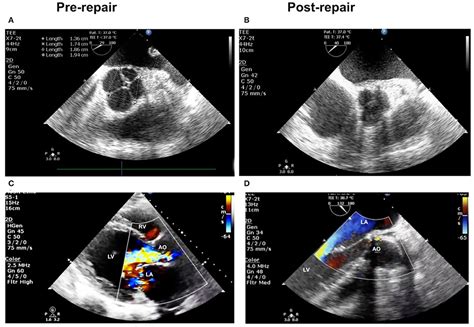 Frontiers Surgical Repair Of A Quadricuspid Aortic Valve With Severe