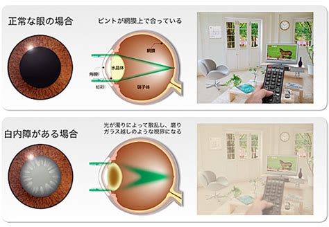 病気について さくら眼科