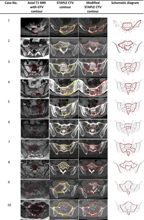 International Consensus Recommendations For Target Volume Delineation