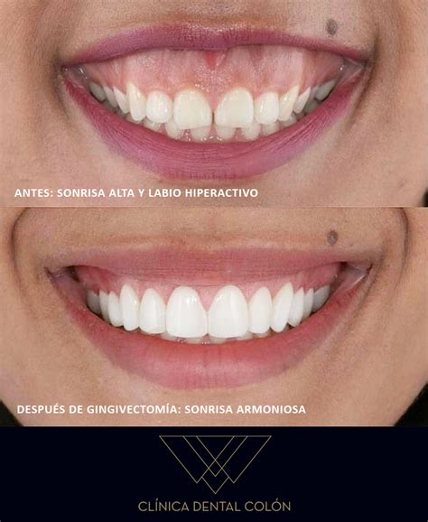 Todo Sobre La Gingivectom A Resuelve Tus Dudas Cl Nica Dental