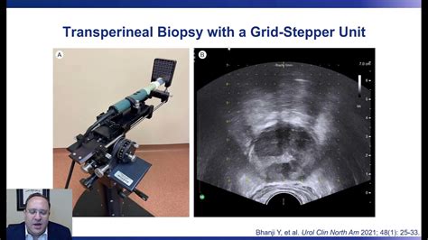 Transperineal Prostate Biopsy A New Standard Of Care Youtube