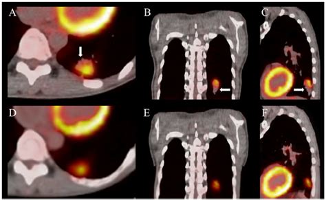 Represents The PET CT Fusion For Tumor Contour Delineation The Arrows