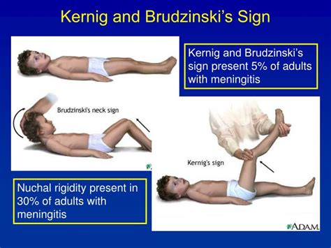 PPT - Meningitis PowerPoint Presentation - ID:4591726