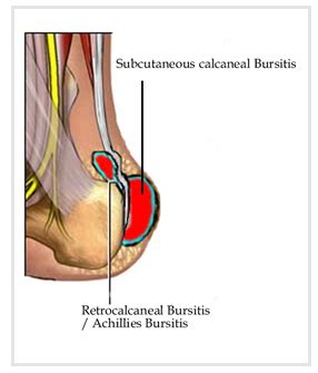 Retrocalcaneal Bursitis Treatment | OSMO Patch US