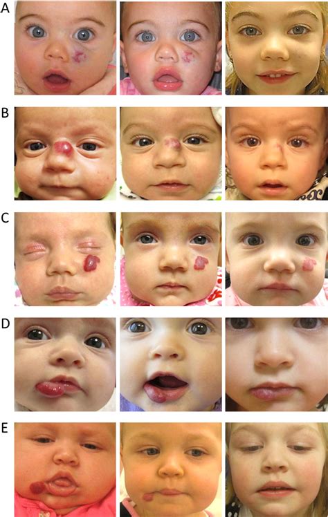 Management Of Problematic Infantile Hemangioma Using Intralesional