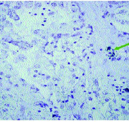 Mast cells in tumoral tissue that stained positively with mast cell ...