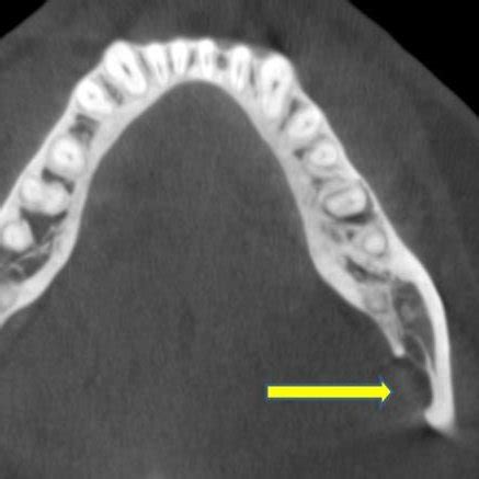 Axial Cbct Section Showing The Lingual Location Of The Bony Depression