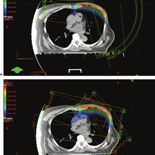 Treatment Planning In 1 Representative Patient A VMAT B IMRT