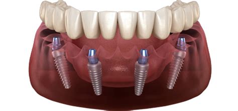 Dentisti In Albania Clinica Dentale Trio In Tirana