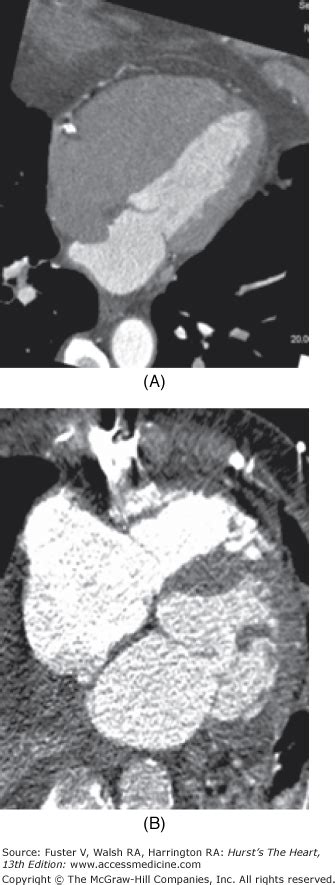 Computed Tomography Of The Heart Thoracic Key