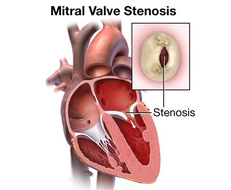 Mitral Valve Stenosis