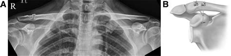 Arthroscopic Assisted Double Bundle Coracoclavicular Ligament