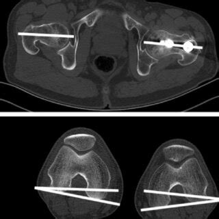 measurements  femoral anteversion degree  axial ct view