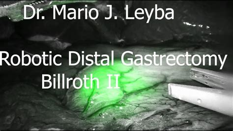 Robotic Distal Gastrectomy With Billroth Ii Youtube