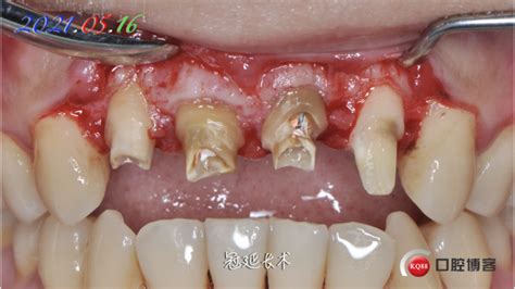 一例前牙二次修复and冠延长 郑越广的博客 Kq88口腔博客