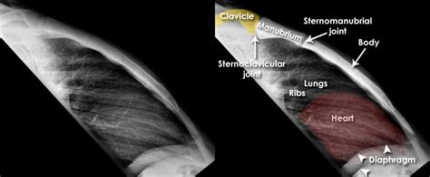 Trauma X-ray - Axial skeleton - Sternum