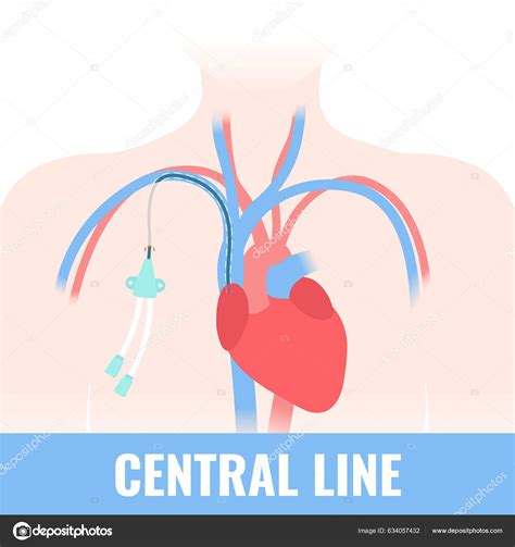 Tunneled Central Venous Catheter Placed Subclavian Vein Patient Cvc Long Stock Vector Image By