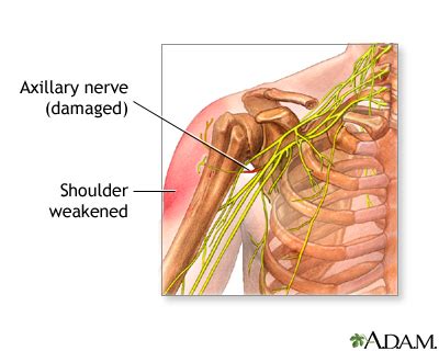 Axillary nerve dysfunction | UF Health, University of Florida Health