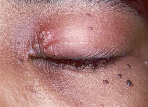 Pimple On Eyelid Types Causes And How To Treat Them