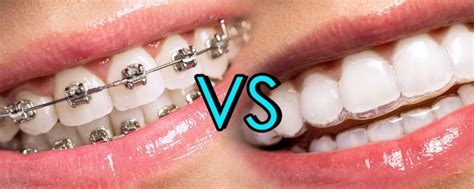 Invisalign Vs Braces Cost North Sydney Dentistry