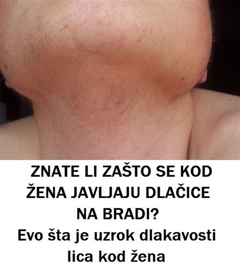 ZNATE LI ZAŠTO SE KOD ŽENA JAVLJAJU DLAČICE NA BRADI Evo šta je uzrok