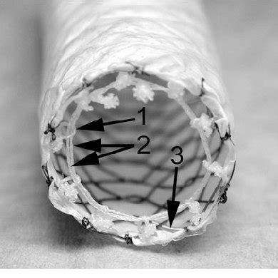 Retrievable stent removal procedure. a After the retrieval hook ...