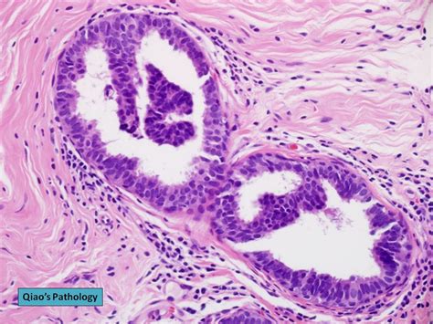 Qiao S Pathology Micropapillary Dcis A Photo On Flickriver