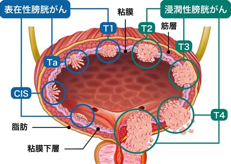 膀胱がんの治療について 医療法人社団實理会 東京国際大堀病院