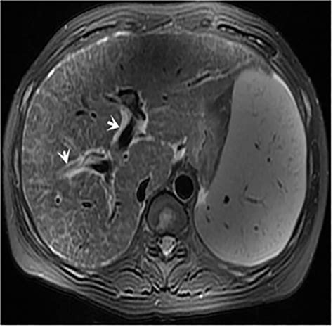 Female 42 Years Axial T2 Weighted Image Shows Splenomegaly And