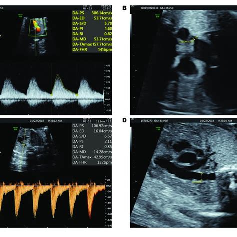 fetal ductus arteriosus constriction  blood flow spectrum