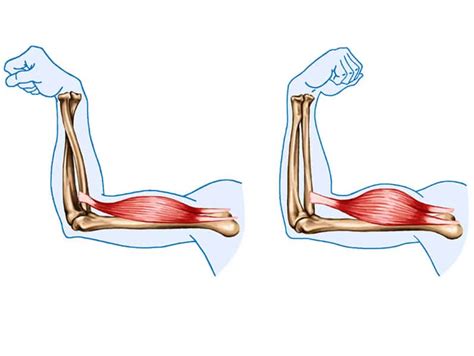 Distal Biceps Tendon Tear: Causes, Symptoms & Treatment | Melbourne