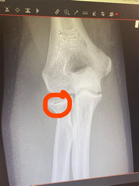 Broken elbow : r/brokenbones