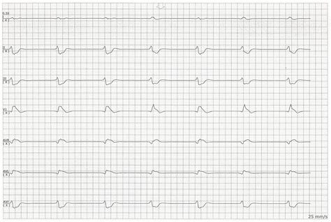 Float Nurse: Idioventricular rhythm