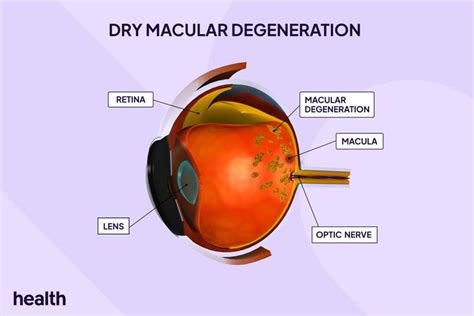 Dry Macular Degeneration (Dry AMD): Symptoms & Treatment