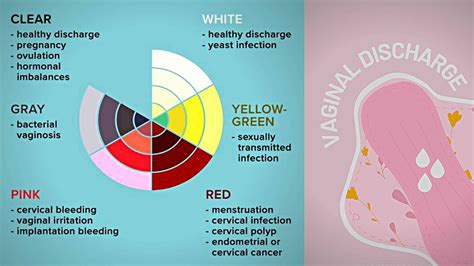 Vaginal Discharge Guide With Color Code