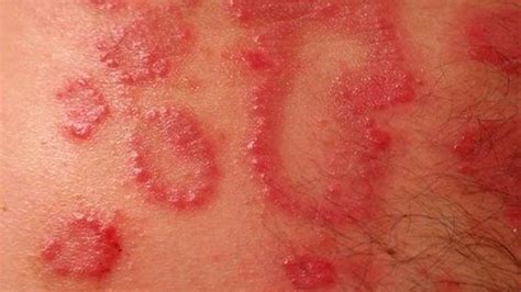 megsért kereszt Asszimiláció cuáles son las causas de la dermatitis