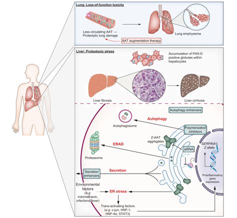 Alpha 1 Antitrypsin Deficiency A Re Surfacing Adult Liver Disorder