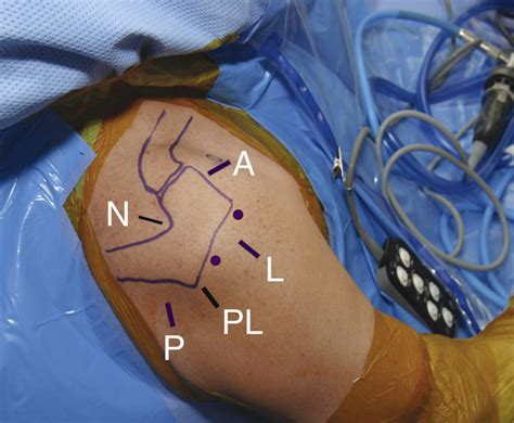 Arthroscopic Rotator Cuff Repair Musculoskeletal Key