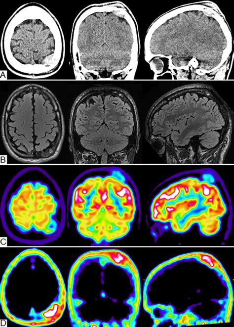 Guided Resection Of A Primary Intraosseous Meningioma Technical Note