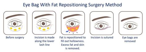 Eye Bag Removal in Singapore - Aesthetic or Plastic Surgery?