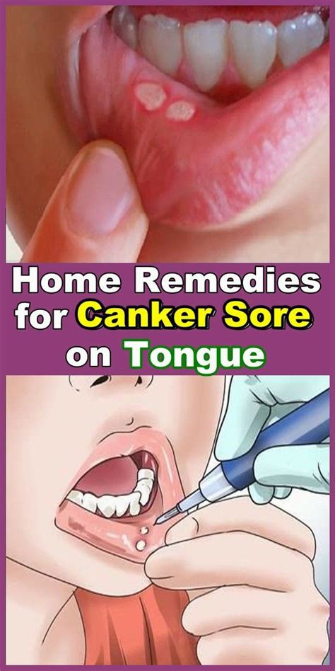 Home Remedies for Canker Sores on Tongue